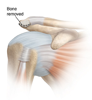 Front view of shoulder joint showing tendon released and bone to be removed.