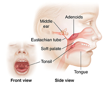 Front view of child's open mouth with tonsils. Side view of child's face showing tonsils, adenoids, and inner ear.