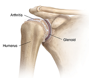 Front view of shoulder joint with arthritis.