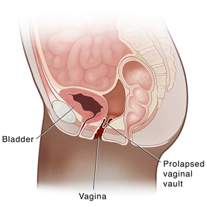Side view cross section of female pelvis showing vaginal vault prolapse.