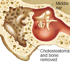 Cross section through mastoid bone and middle ear showing bone after cholesteatoma removed.
