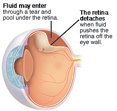 Three-quarter view of cross-sectioned eye showing detached retina.
