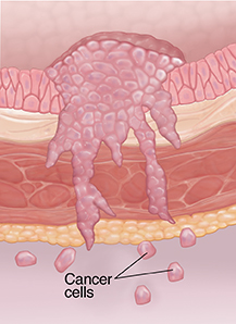 Cross section of bladder wall showing cancer at metastatic stage.