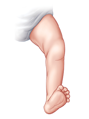 Contorno de la pierna del bebé que muestra el pie apuntando hacia arriba y hacia afuera (pie calcáneo valgo).