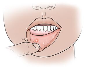 Primer plano de una boca con un dedo que jala para abajo el labio inferior para mostrar un afta.