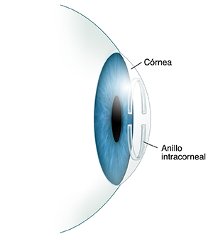 Vista lateral de un ojo donde se observa el anillo corneal en la córnea.