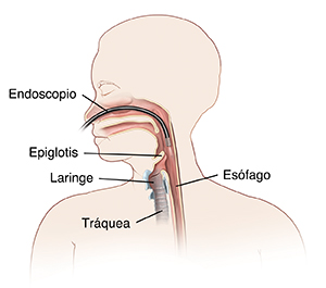 Contorno de una mujer donde se observa el endoscopio insertado a través de la nariz en la garganta justo encima de la epiglotis.