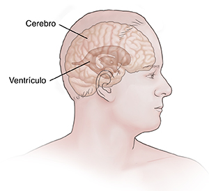 Vista frontal de la cabeza y del tórax de un hombre donde se observan el cerebro y los ventrículos.