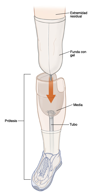 Todas las partes de una prótesis por debajo de la rodilla.