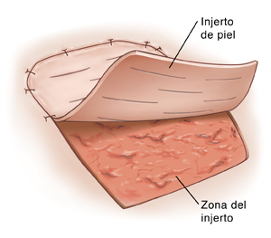 Vista superior de un injerto de piel para reparar una herida.