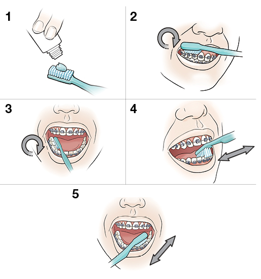 5 pasos para cepillar sus dientes y frenos