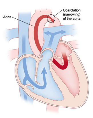 Corte transversal de vista frontal de un corazón que muestra coartación (estrechamiento) de la aorta. Unas flechas muestran que la sangre circula desde el lado izquierdo del corazón, pasa por la aorta, y su paso se obstruye (bloquea) parcialmente por el estrechamiento. Otras flechas muestran la circulación de la sangre del lado derecho del corazón por la arteria pulmonar. 