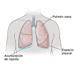 Contorno del cuello y el pecho de un hombre en el que se ve acumulación de líquido debajo del pulmón derecho.