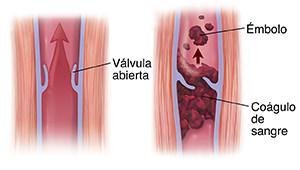 Corte transversal de músculo y vena donde se ve una válvula abierta con una flecha que muestra la sangre subiendo. Corte transversal de vena varicosa con trombo y émbolo.
