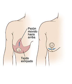 Dos imágenes de un pecho femenino que ilustran el seno derecho: la primera figura muestra incisiones para una mamoplastia de reducción vertical; la segunda imagen muestra el resultado.