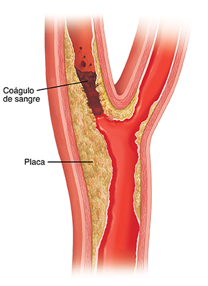 Corte transversal de una arteria carótida donde se ven la acumulación de placa y un coágulo de sangre.