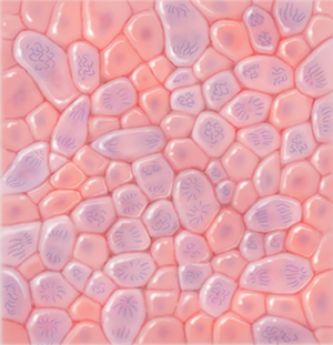 Vista microscópica de células cancerosas de grado alto.