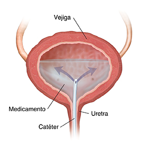 Corte transversal de una vejiga en donde se ve un catéter insertado a través del uréter, que libera medicamento.