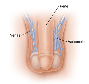 Vista frontal de los genitales de un hombre con varicocele.