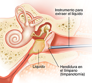 Corte transversal del oído de un niño donde puede verse líquido en el oído medio y la trompa de Eustaquio inflamada, otitis media aguda (OMA). Un instrumento extrae líquido del oído interno.