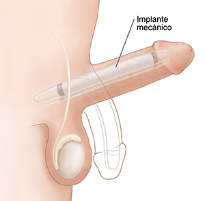 Vista lateral de un pene con un implante maleable en una posición relajada.