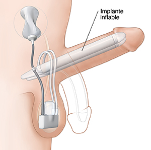 Vista lateral de un pene con un implante inflable dentro.