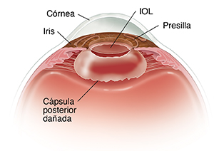 Corte transversal del frente de un ojo en donde se ve la LIO en la cápsula anterior.