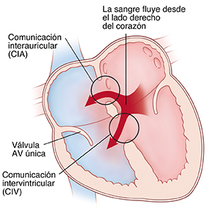 Corte transversal de vista frontal de un corazón donde pueden verse las aurículas arriba y los ventrículos abajo. La comunicación interauricular (CIA) se encuentra en el tabique entre las aurículas. La comunicación interventricular (CIV) se encuentra en el tabique entre los ventrículos. Solo hay una válvula auriculoventricular. Las flechas muestran la circulación de la sangre del lado izquierdo del corazón al derecho.