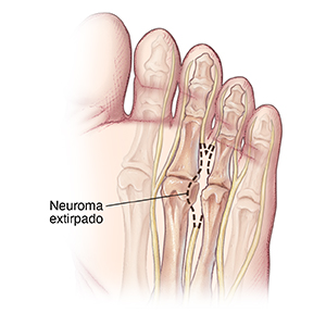 Vista inferior de un pie con una línea de puntos donde se observa un neuroma extirpado entre los huesos de los dedos.