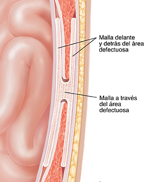 Corte transversal de una pared abdominal donde puede verse la reparación con malla por delante, a través y detrás de la hernia.