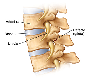 Vista lateral de vértebras con espondilólisis que muestra un defecto (rotura) en la parte trasera de una vértebra, el nervio y el disco.