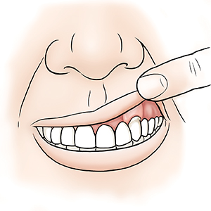 Primer plano de una boca con un dedo que levanta el labio superior para mostrar que el borde de las encías se emparejó con la cirugía.