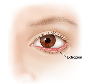 Vista frontal de un ojo donde se observan el párpado inferior caído y el ectropión.