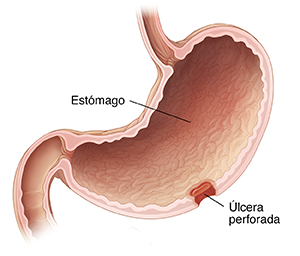 Corte transversal del estómago donde puede verse una úlcera perforada.
