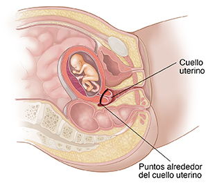 Corte transversal de la pelvis y el abdomen de una mujer donde se observa el feto en el útero y el punto de sutura que mantiene el cuello uterino cerrado.