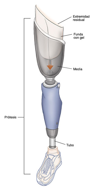 Todas las partes de una prótesis por encima de la rodilla.