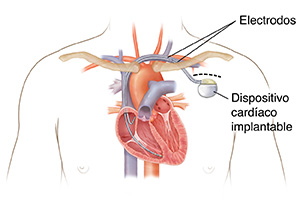 Contorno del pecho de un hombre en el que puede verse un marcapasos colocado con cables que van hacia las cámaras del corazón.