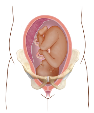 Vista frontal de un corte transversal de un útero en los huesos pélvicos donde se observa un feto con la cabeza muy grande como para pasar por la vía del parto.