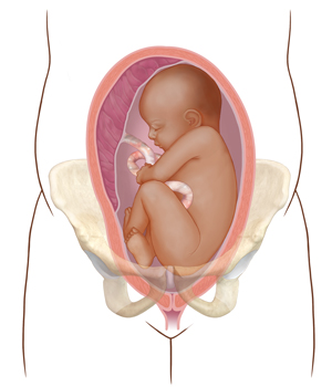 Vista frontal de un corte transversal de un útero en los huesos pélvicos donde se observa un feto con la cabeza hacia arriba, en una posición incorrecta para el parto.
