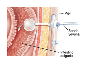 Corte transversal de cuerpo humano donde puede verse una sonda de yeyunostomía introducida en el intestino delgado.