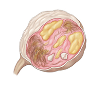 Corte transversal de un ovario con un quiste dermoide.