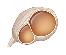 Vista frontal de un ovario con un cistoadenoma benigno.