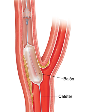 Corte transversal de la arteria carótida que muestra acumulación de placa. Se ve un catéter con balón insertado después de la placa.