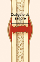 Corte transversal de un hueso fracturado que muestra un coágulo sanguíneo que se está formando en el lugar de la fractura.