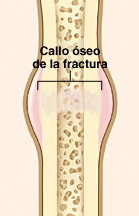 Corte transversal de un hueso fracturado que muestra un callo que se está formando en el lugar de la fractura.