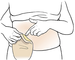 Primer plano de un abdomen donde pueden verse manos que retiran la bolsa de ostomía.