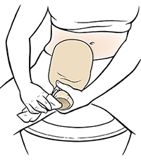 Woman sitting on toilet cleaning ostomy pouch.
