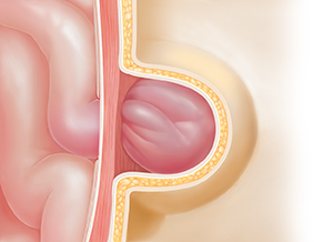 Cross section of body wall showing hernia. Intestine protruding through and trapped in defect in muscle underneath skin.