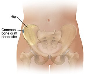 Front view of female lower abdomen showing pelvic bones. Blue area shows possible bone graft donor site.