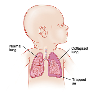 Closeup of baby with head turned to side showing airway and lungs. One lung has trapped air around it, and lung is collapsed.
